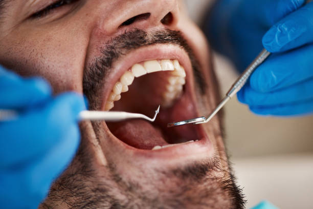 Best Emergency Wisdom Tooth Extraction in Oasis, CA